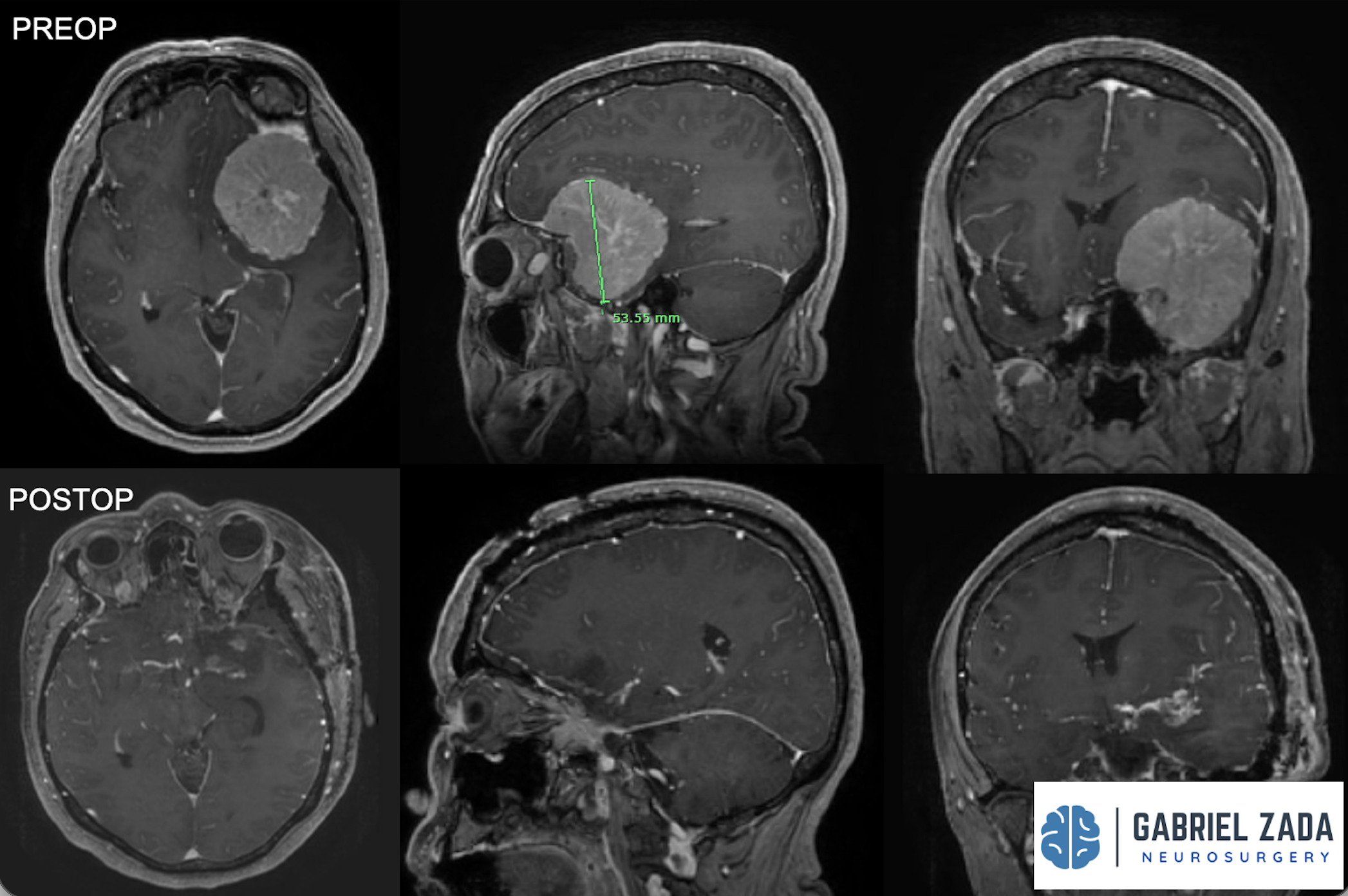 Meningioma Surgery Treatment In Los Angeles — Gabriel Zada